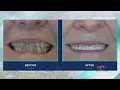 ClearChoice Dental producing amazing dental implant makeover results