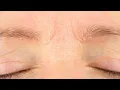 Why Do My Eyebrows Itch and Flake During the Winter