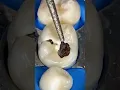 Lagu how to remove cavity from tooth ll #shorts