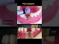 Download Lagu How is dental implant?