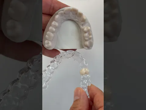 Essix appliance for Dr. Joseph Rigg in South Dakota