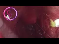 Download Lagu Alamak, kenapa nafas berbau ni... tekak pula tak selesa ...  nanah ke tonsil saya ???