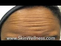Botox Services at Skin Wellness Center of Alabama