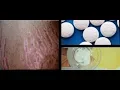 Get Rid of Stretchmarks Very Fast Using Aspirin