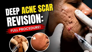 Can Deep Acne Scars Be Removed? Watch This Procedure! | Clear Skin Clinic, Pune