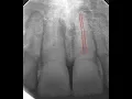Navident ENDO