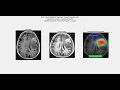 Brain Tumor Detection using Deep Learning