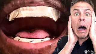 Did Kanye West REALLY Spend 850 000 To Replace His Teeth