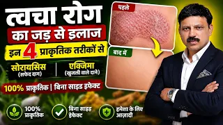 Skin Disease जैसे सोरायसिस और एक्जिमा का Permanent इलाज | Manas Samarth