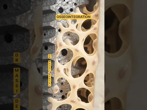 OSSEOINTEGRATION 🦷😬