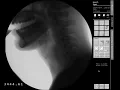 Swallow Study - Thin Liquid