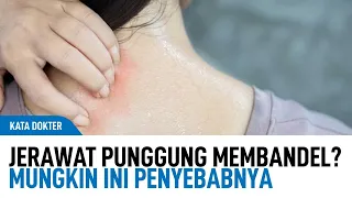 cara mengatasi jerawat di punggung dari dokter kulit kata dokter
