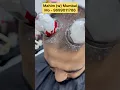 Download Lagu Can hijama regrow hair? ( Regrowth hair by Hijama )#hair#haircare#hairfall#hairstyle#haircut#shorts