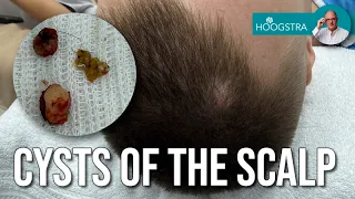 Sebaceous cysts of the scalp