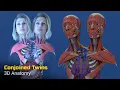 Two Heads One Body Anatomy of Conjoined Twins