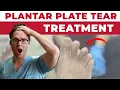 Plantar Plate Tear Taping Technique That Actually Works