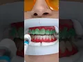Laser teeth whitening before and after