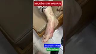  เก๊าทเป็นโรคอะไร และเกิดจากสาเหตุใด 