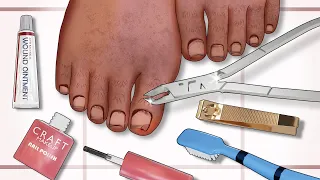 ASMR Ingrown Toenail Removal// Satisfying Feet & Nail Care Animation