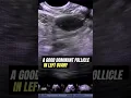 Download Lagu Dominant Ovarian Follicle   #Ultrasound #pregnancy #infertility #ovulation
