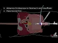 Laparoscopic-Assisted Percutaneous Endoscopic Gastrostomy PEG Tube Placement Steps