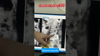 ทำไมคนที่เคยผ่าตัดยึดกระดูกหลังแล้ว ถึงอาจมีอาการปวดหลังกลับมาในระยะยาว