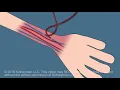 Download Lagu Dialysis Fistula animation