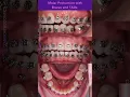 Closing missing tooth space by protracting molars forward with braces and TADs