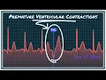 Premature Ventricular Contrcations - Ventricular Bigeminy Trigeminy Quadrigeminy