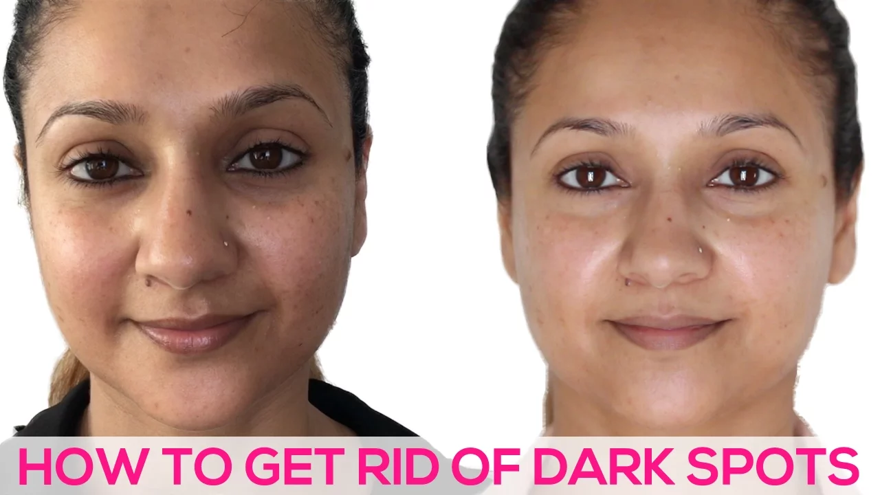 Serum Pilihan Untuk Menghilangkan Dark Spots! | Skincare 101