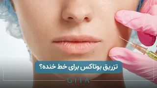 تزریق بوتاکس برای خط خنده 