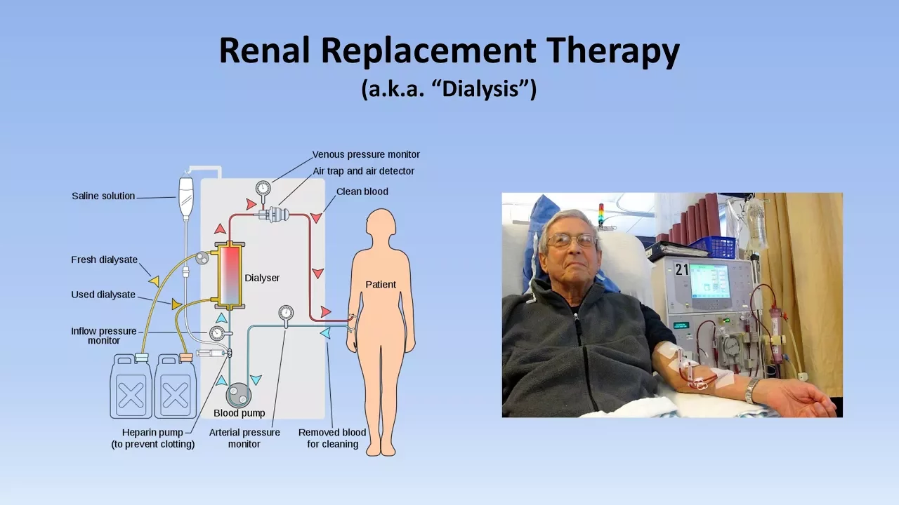 Acute Kidney Injury (Part 3/3 - Treatment and Complications)