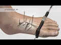 Lagu dynaBunion™ 4D Minimal-Incision Lapidus System - Surgical Animation