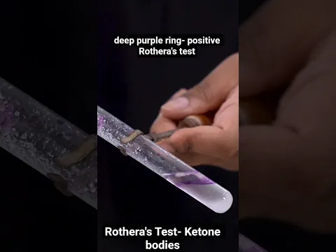 Rothera's test- Ketone bodies, Practical skill videos 3.0 @pwmeded