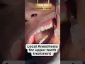 Download Lagu Local Anesthesia For Upper Teeth Treatment || Happy Smiles Dental Care || #shorts