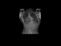Mayo Clinic Minute Scoliosis Awareness