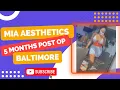 5 MONTHS POST OP MIA AESTHETICS BALTIMORE 360 LIPO