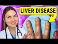 Lagu 12 Signs of LIVER DISEASE You Can See: Doctor Explains