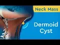 Neck Mass Dermoid Cyst