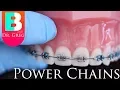 BRACES EXPLAINED Power Chains