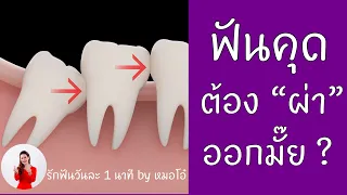 การผ่าฟันคุดสามารถทำได้หลังจากจัดฟันด้วยเหล็กแล้วหรือไม่  และทำไมบางครั้งจึงเลือกผ่าทีละซี่ระหว่างการจัดฟัน