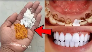 The recipe that dentists are hiding from us🔥!It whitens teeth and eliminates tartar in 1 minutes