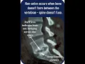 Bone Growth Stimulators should I use one how they work how long do I need to wear it