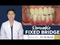 FLEXIBLE DENTURE THAT LOOKS LIKE A FIXED BRIDGE BRIDGE BUT REMOVABLE