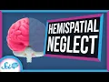 Hemispatial Neglect When Half Your World Disappears