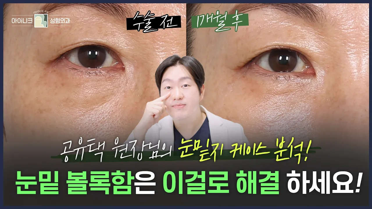 여름인데 통통한 눈 밑 살도 다이어트해야지?😎 | 눈밑 끝판왕 공유택 원장님의 케이스 리뷰-!