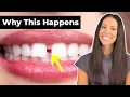 Why Do People Have GAP TEETH How To Fix It Diastema Explained