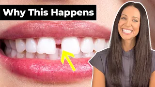 Why Do People Have GAP TEETH How To Fix It Diastema Explained