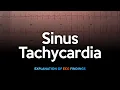 Download Lagu Sinus Tachycardia ECG
