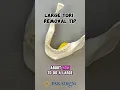 Large Tori Removal Tip